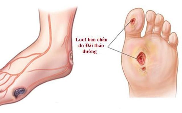 Biến chứng bàn chân do đái tháo đường